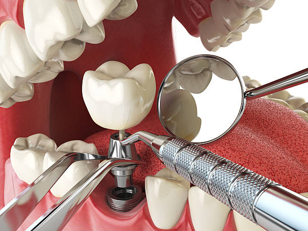 Best Emergency Root Canal Treatment in Daleville, VA